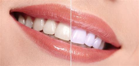 Glo Teeth Whitening - Divine Dental