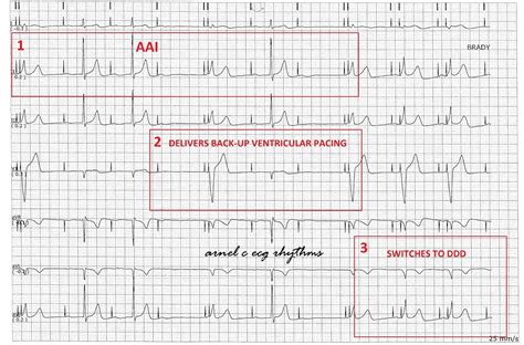 ECG Rhythms: Managed Ventricular Pacing