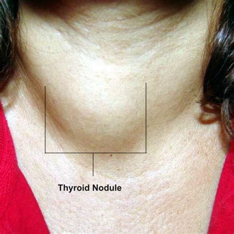 Toxic Thyroid Adenoma: Causes, Symptoms, Treatment