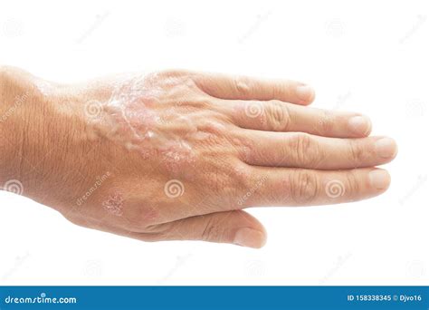 Psoriasis Vulgaris and Fungus on the Man Hand with Plaque, Rash and Patches on the Skin ...