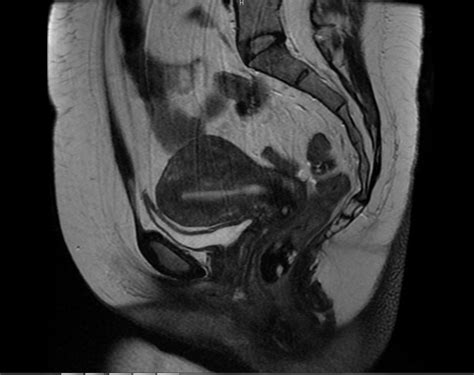 MR PELVIS WITH AND WITHOUT IV CONTRAST - Greater Waterbury Imaging Center