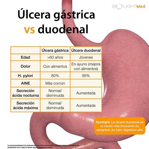 Diferença Entre Gastrite E Ulcera - BRAINCP