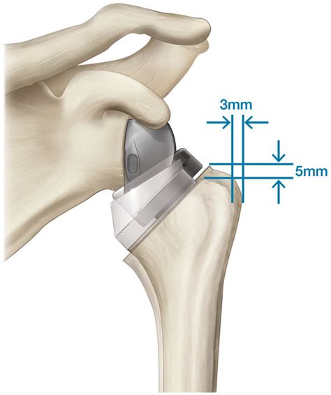 JFMK | Free Full-Text | Reverse Shoulder Arthroplasty Biomechanics