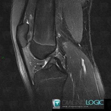 Radiology case : Patella alta (MRI) - Diagnologic