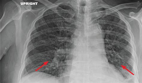 Miliary tuberculosis in a patient with end-stage liver disease ...