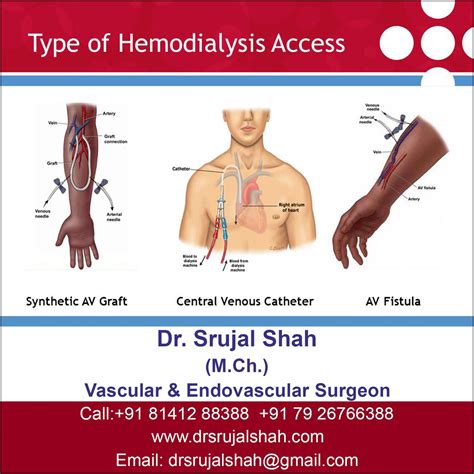 Dialysis Catheter Types