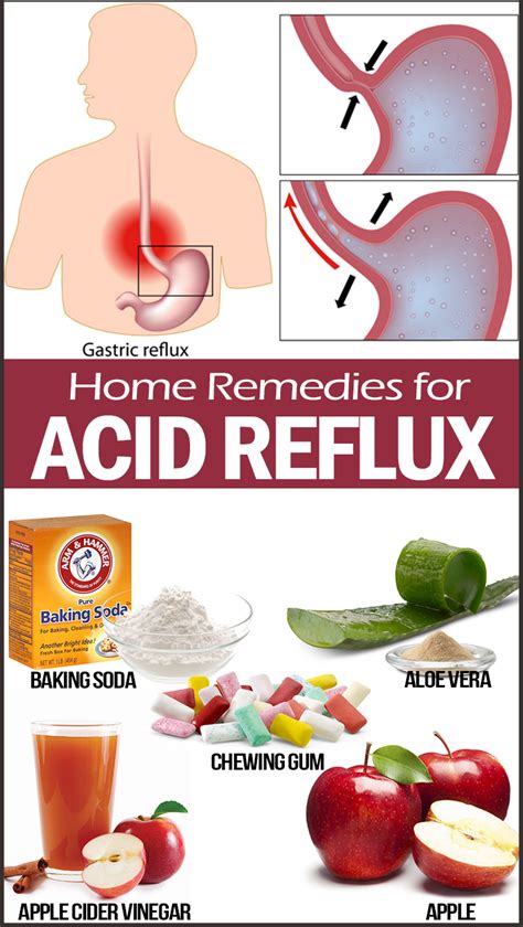 25+ bästa Remedy for acid reflux idéerna på Pinterest | Halsbränna och ...