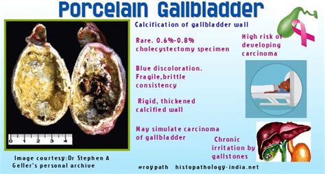 Pathology of the Porcelain Gallbladder | Gallbladder, Porcelain, Pathology