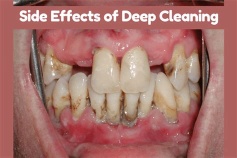 Deep Cleaning of Teeth Side Effects - How to Overcome it?