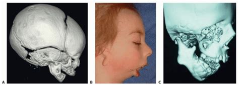 External Mandibular Distraction for Micrognathia | Plastic Surgery Key