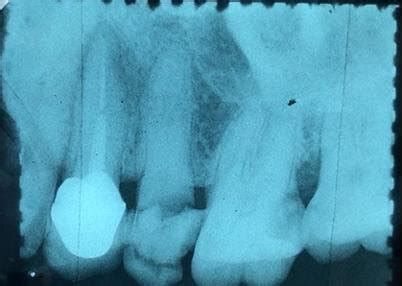 The condition of deep carious teeth before the treatment. a.) Initial... | Download Scientific ...