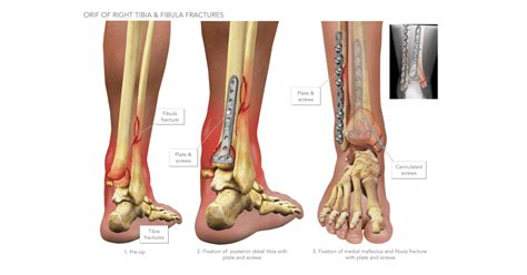 Tibia And Fibula Fractures High Impact Visual Litigation Strategies | My XXX Hot Girl