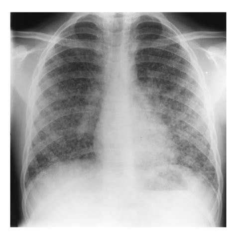 Histoplasmosis Lung