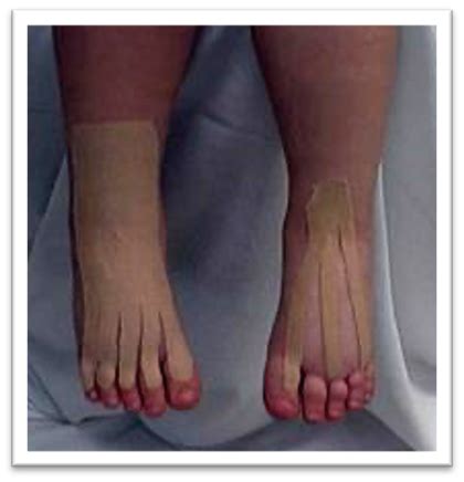 A Guide to Lymphedema Bandaging in Children