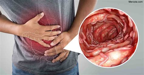 Everything You Need to Know About Ulcerative Colitis