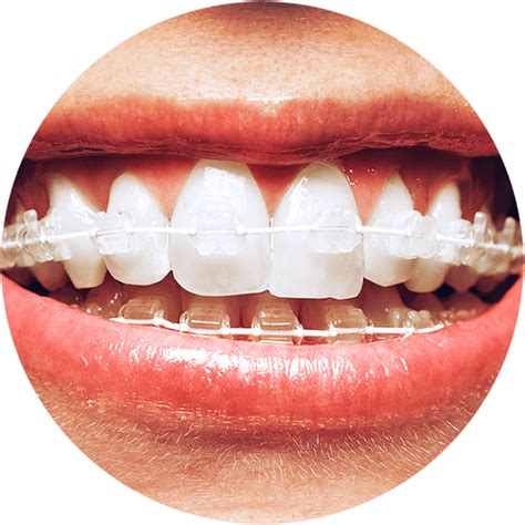 How Do Braces Work with Six Month Smiles?