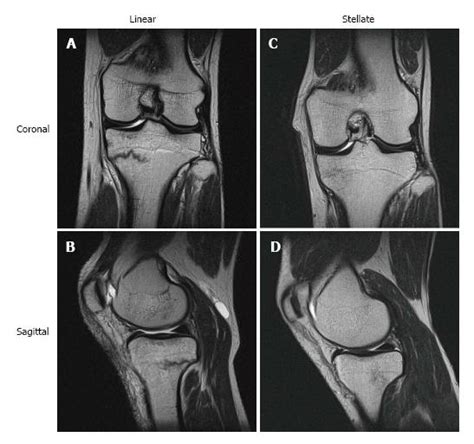 Tibial Plateau Fracture Mri