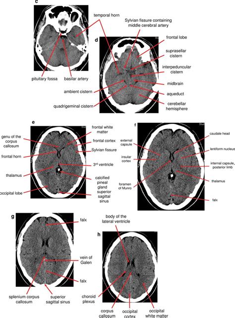 Anatomy Of Head Ct Scan Normal The Brain On Ct And Mri With A Few ...