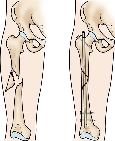 Closed Femur Fracture