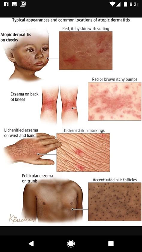 Pin by HAV Skincare & Wellness Center on Skin Conditions | Atopic dermatitis, Dermatology nurse ...