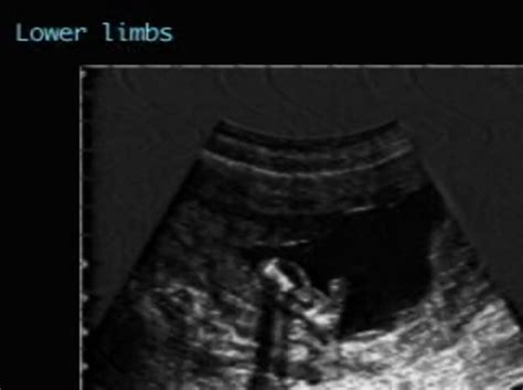 Campomelic dysplasia – ULTRASOUNDPAEDIA