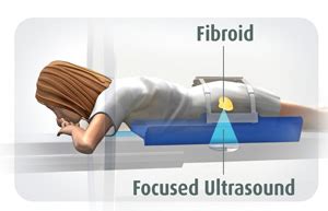 Uterine fibroids treatment - Women Health Info Blog