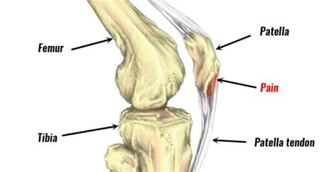 Patellar tendinitis : Cause, Symptoms, Treatment, Exercise