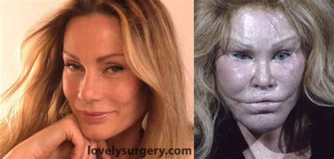 How Plastic Surgery Created the Catwoman - Lovely Surgery