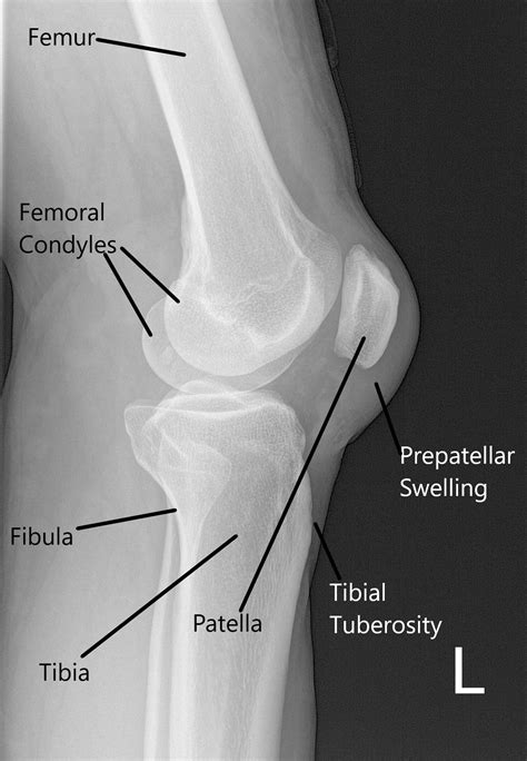 Case Study: Left Knee Tear Management in 55 yr. Old Female