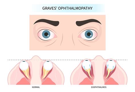 Thyroid Eye Disease (TED) Treatment in Kansas City, MO | Discover Vision