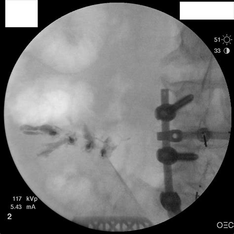 Superior cluneal nerve pulsed radiofrequency treatment | Student Doctor Network