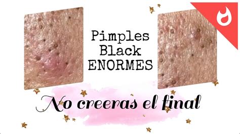 blackhead satisfying pimples - grandes puntos negros - YouTube