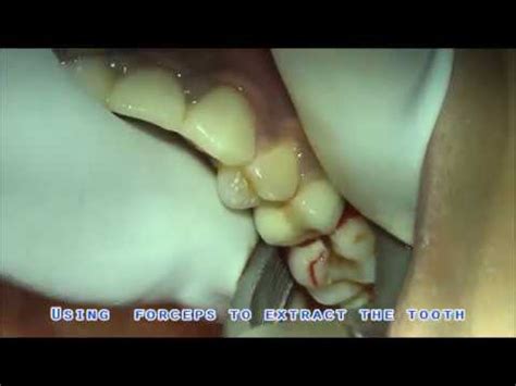 Extraction of upper 1st molar using forceps - YouTube