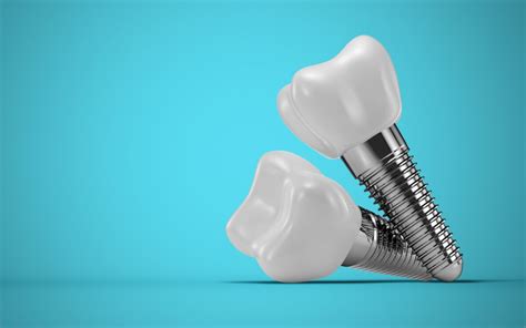 All You Need to Know About Titanium Teeth Implants