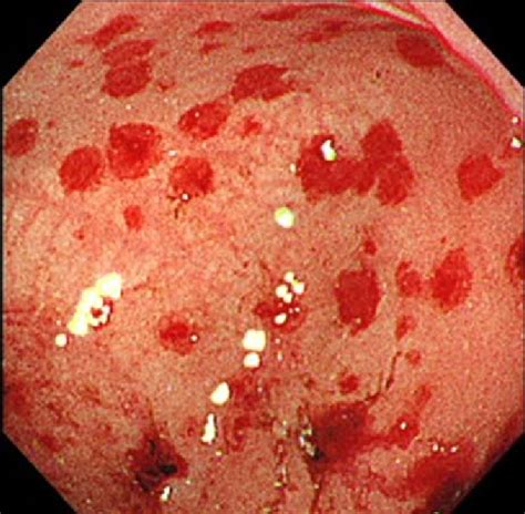 Endoscopic image of the gastric lesions, showing multiple erythematous,... | Download Scientific ...