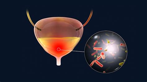 Recurrent Urinary Tract Infections: What's Good Prophylaxis?