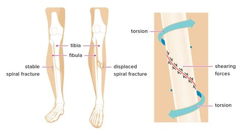 Spiral Fracture: Healing Time, Tibia, and Fibula | Spiral fracture, Fracture healing, Spiral