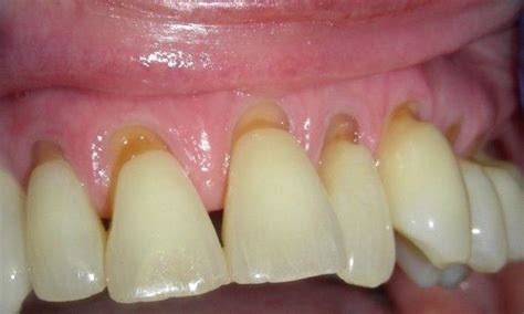 Repair of Tooth Wear with Composite Resin Before & After Photos | New ...