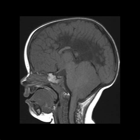 Chiari II Malformation | Pediatric Radiology Reference Article | Pediatric Imaging | @pedsimaging