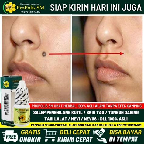 Jual AMAN BPOM - Salep Perontok Kutil, Salep Perontok Tahi Lalat Hidup & Mati di Wajah, Obat ...