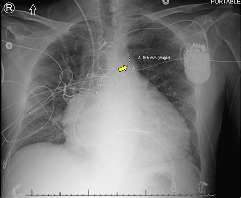 PPT Intra-aortic Balloon Pump (IABP) PowerPoint, 45% OFF