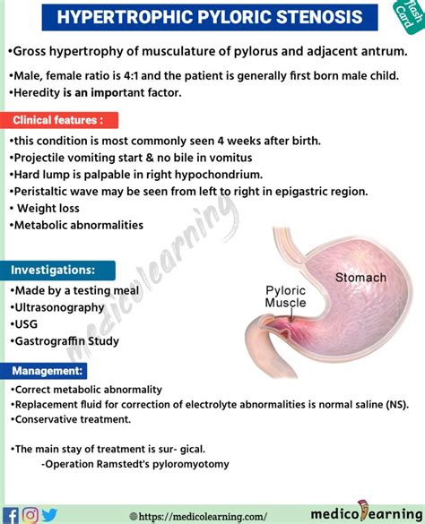 Hypertrophic Pyloric Stenosis – MedicoLearning