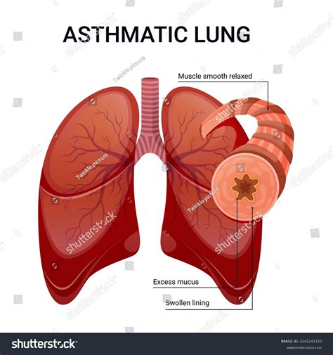 Asthma Lung Vector Diagram Illustration Stock Vector (Royalty Free ...