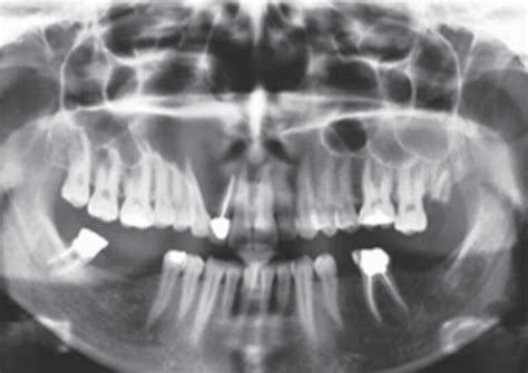 Odontogenic keratocyst, definition, causes, symptoms, diagnosis, treatment & prognosis