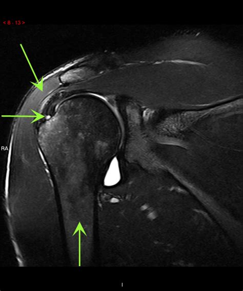 PRP for Small Rotator Cuff Tear (Shoulder) | Cedars-Sinai