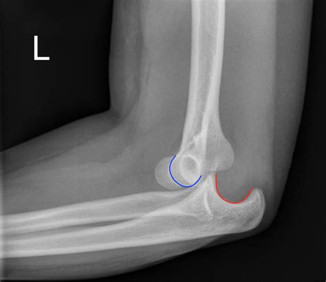 Posterior Elbow Dislocation - JETem