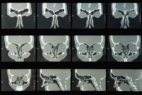 Nasal Polyps Surgery