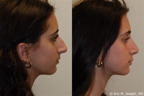 Septoplasty And Turbinate Reduction Before And After