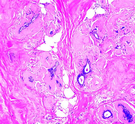 Amyloidosis Histology