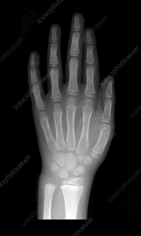 Normal Pediatric Hand X-Ray - Stock Image - C003/4588 - Science Photo ...